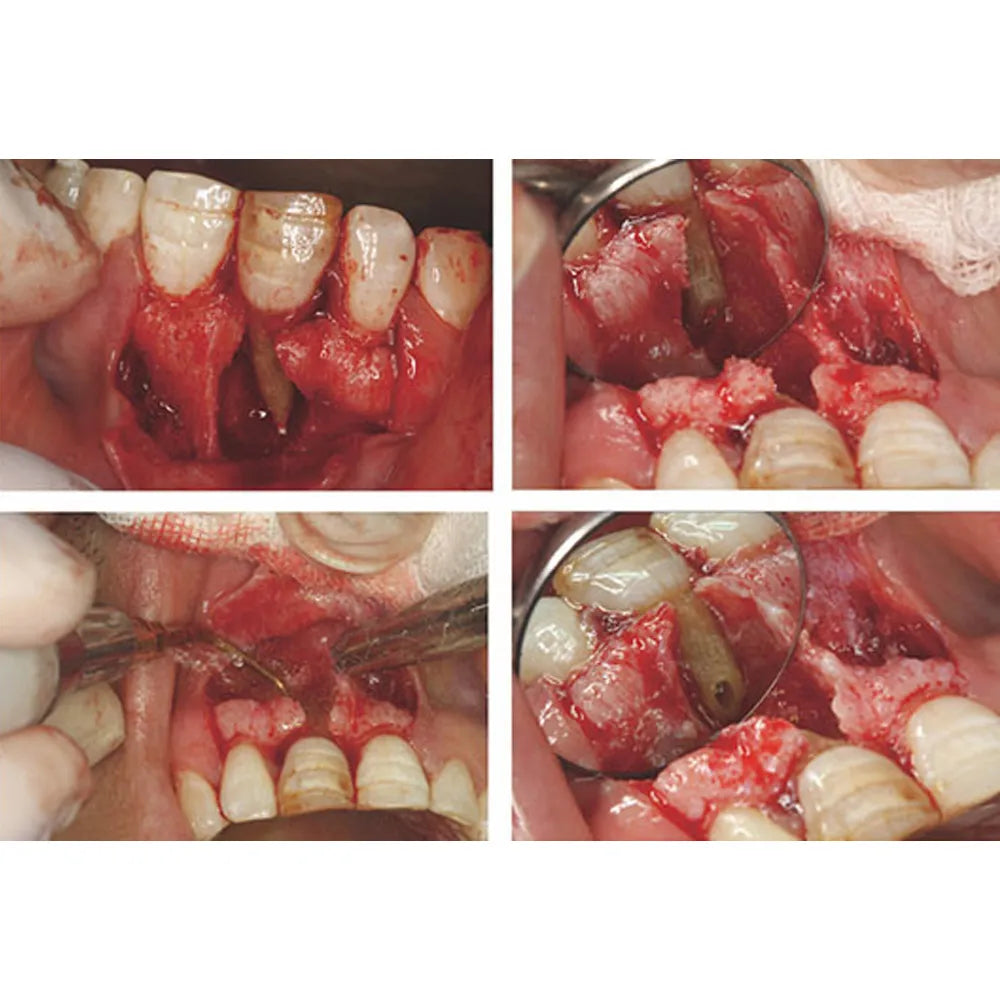 WOODPECKER HB-1L PIEZO BONE SURGERY HANDPIECE