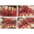 WOODPECKER HB-1L PIEZO BONE SURGERY HANDPIECE