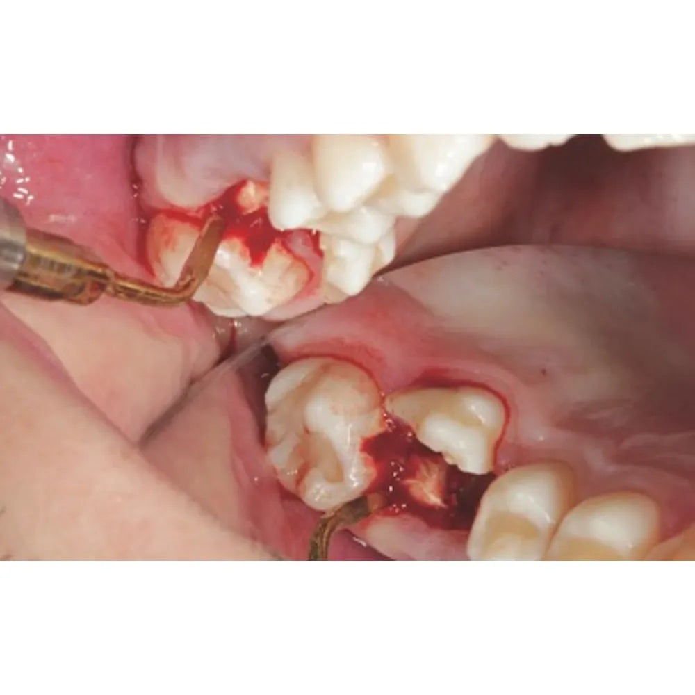 WOODPECKER HB-1L PIEZO BONE SURGERY HANDPIECE