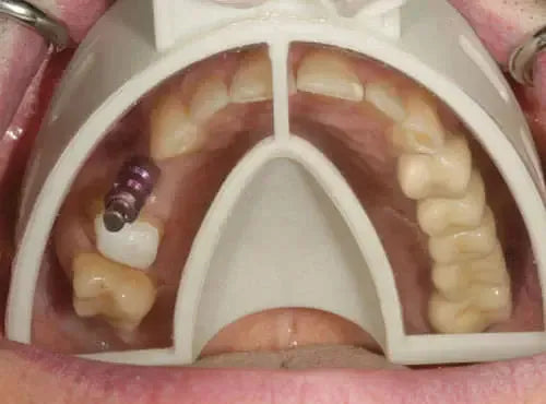 Cotisen Implant Impression Tray