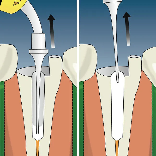 Prevest Calplus apexification and root resorption treatment paste