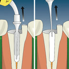 Prevest Calplus apexification and root resorption treatment paste