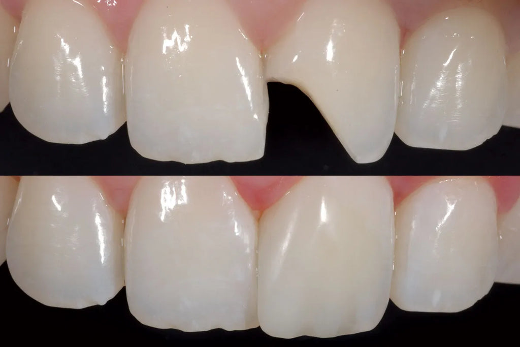 Prevest DenPro Fusion Universal Composite Intro Kit – Light Cure Dental Composite