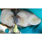 Prevest DenPro CalUltra – Calcium Hydroxide Root Canal Dressing Paste