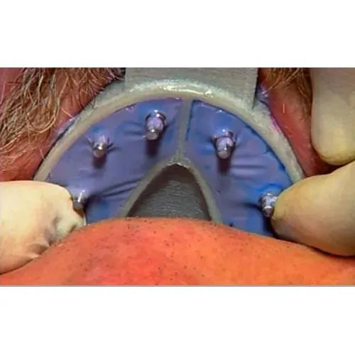 Cotisen Implant Impression Tray