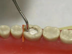 Prevest Zitemp Provisional Filling Material – Temporary Dental Filling Cement