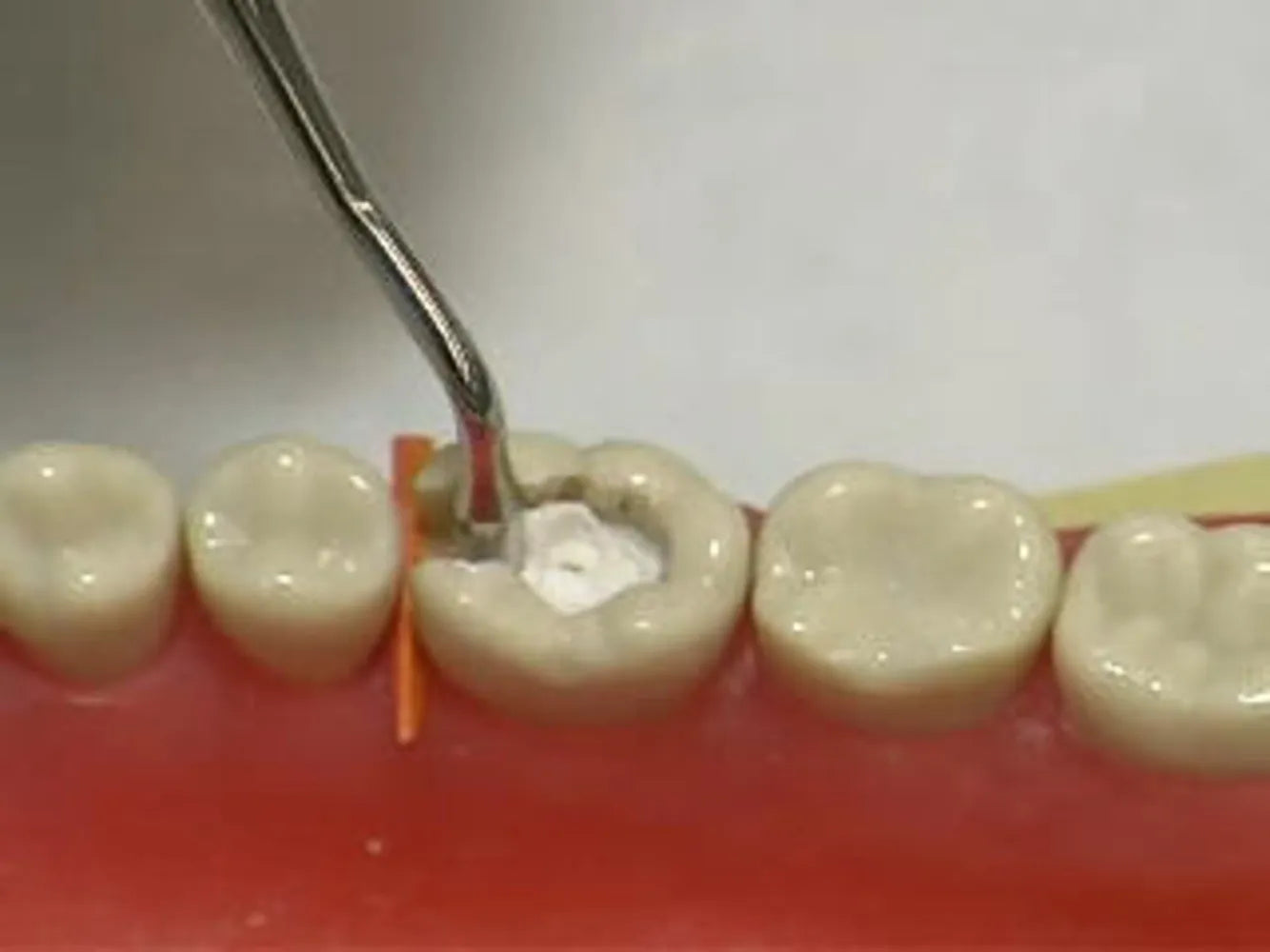 Prevest Zitemp Provisional Filling Material – Temporary Dental Filling Cement