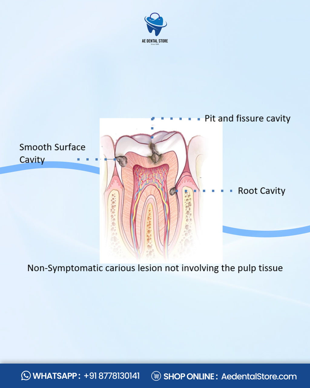 AE Dental e-SDF Caries Arresting Liquid – Silver Diamine Fluoride Treatment
