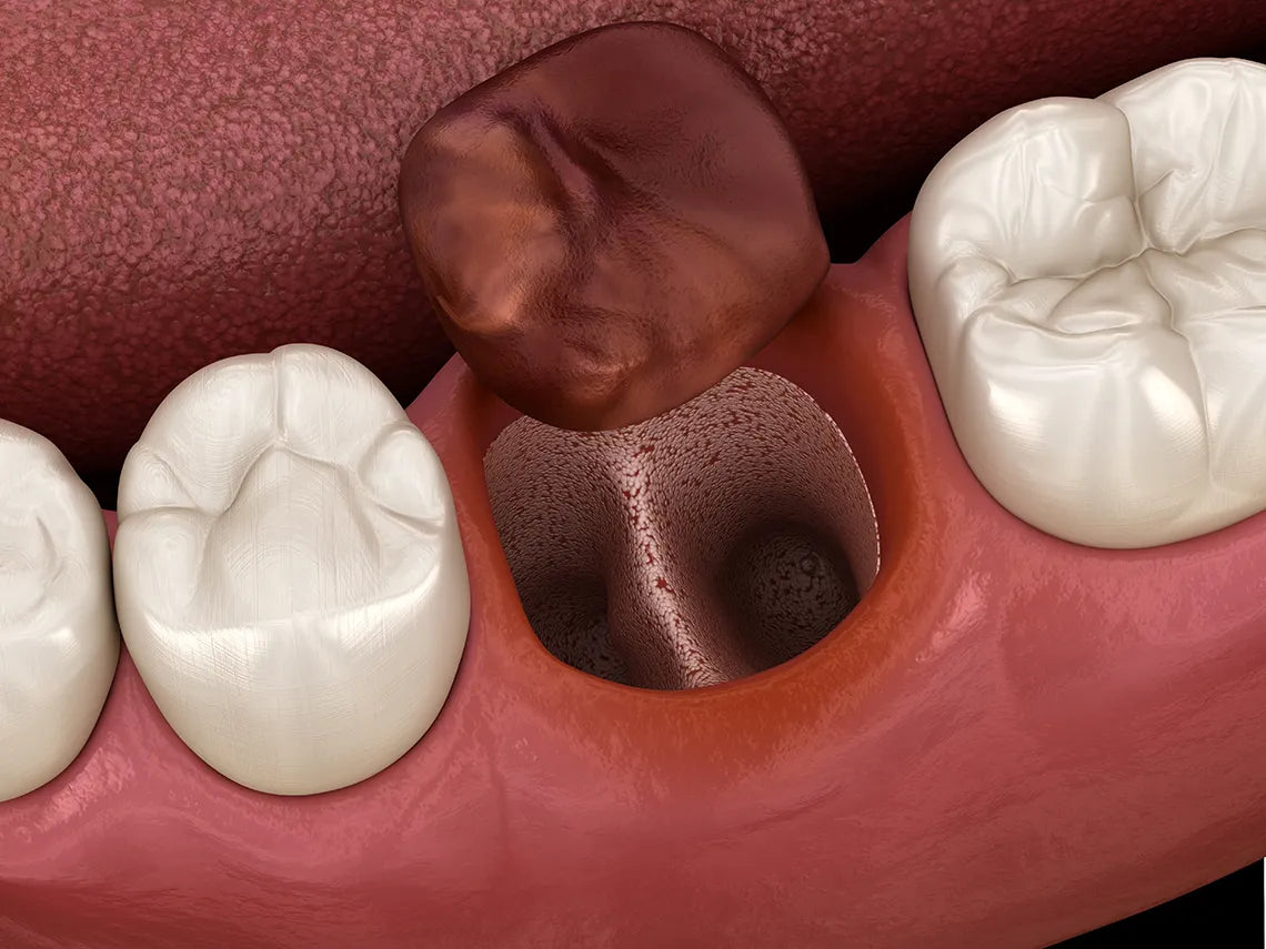Prevest Alvocure Dry Socket Dressing – Post Extraction Socket Treatment
