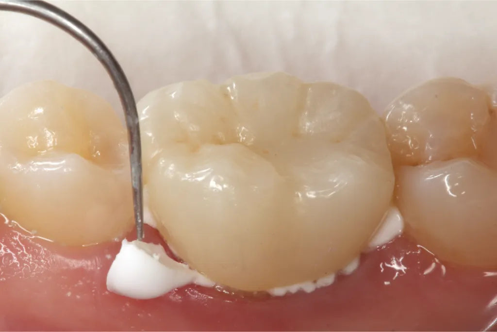 Prevest Crysta GIC Luting Type I – Glass Ionomer Luting Cement for Crowns & Bridges