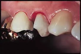 Prevest Hemostal Gel – Dental Hemostatic Gel for Gingival Retraction & Bleeding Control