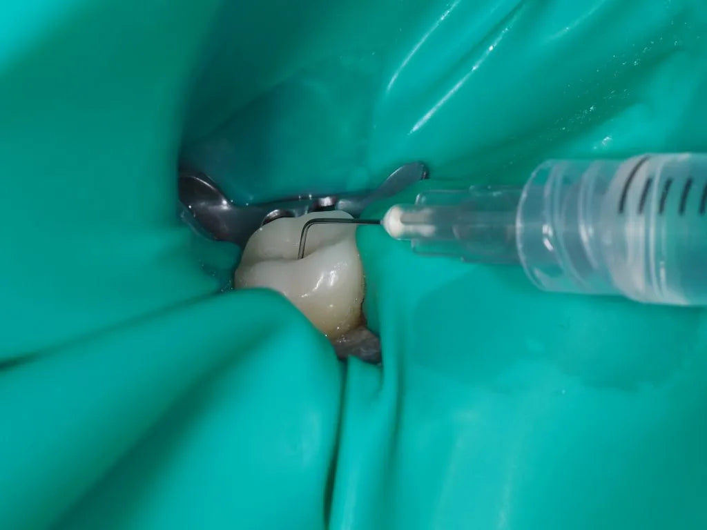 Root canal irrigation procedure using EDTA solution