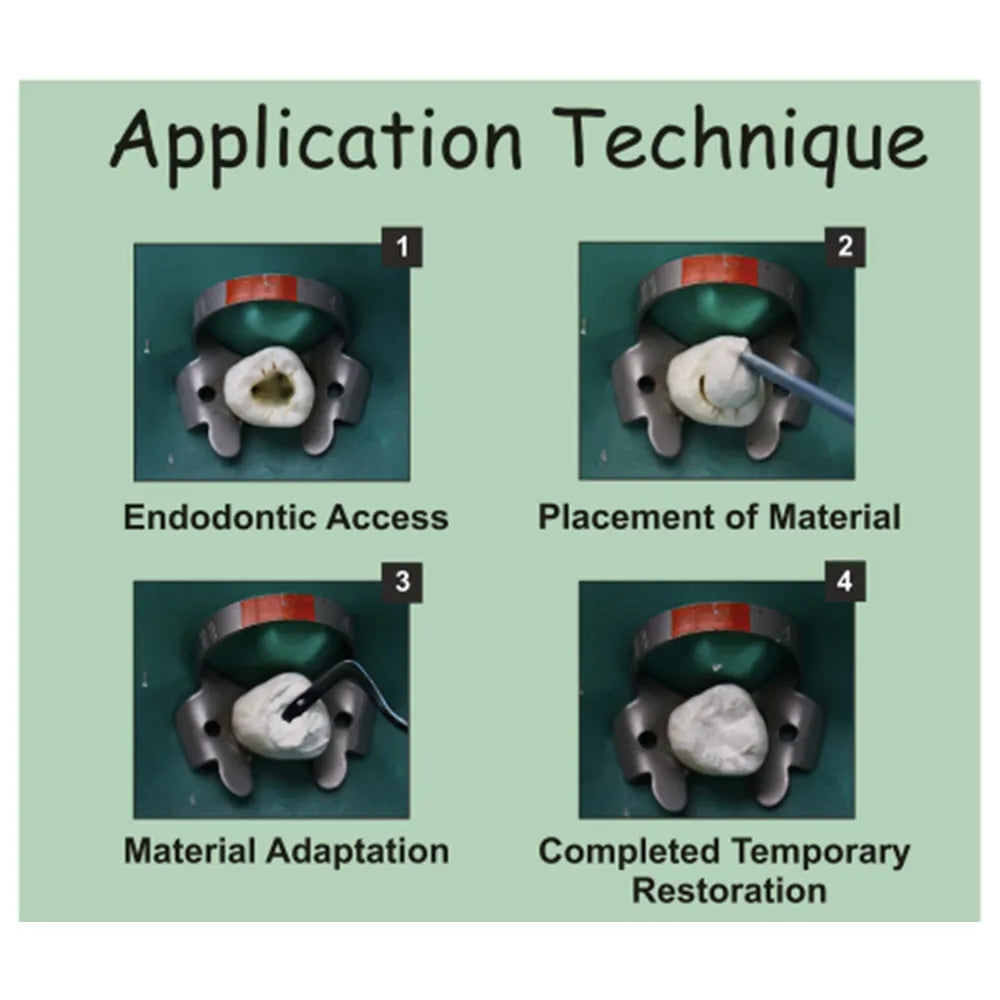 Prevest DenPro Orafil-G Temporary Filling Material – Eugenol-Free Dental Temporary Restoration