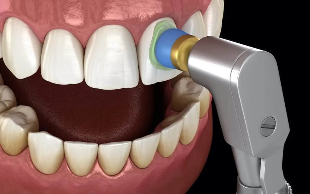 Prevest Spectra Prophy Paste – Fluoride Dental Polishing Paste for Stain & Plaque Removal