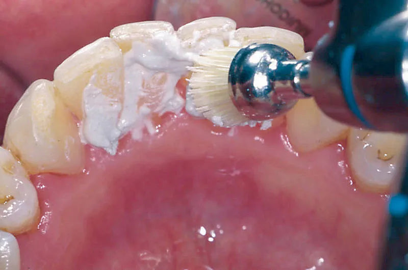 Prevest Spectra Nano Hybrid Composite – Light Cure Dental Restorative Composite