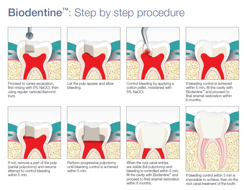 Septodont Biodentine Kit (Pack of 5 Capsules)