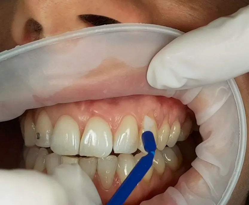 Prevest Shield Activ – Dental Bonding Agent for Composite Restorations