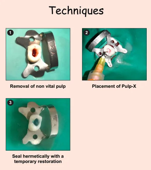 Prevest Pulp X calcium hydroxide endodontic treatment box