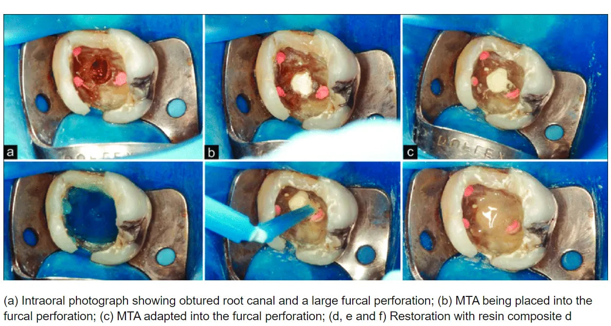 Prevest MTA Plus – Mineral Trioxide Aggregate Root Repair Cement