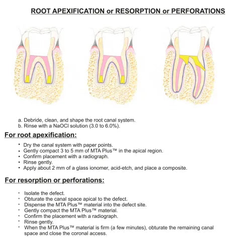 Prevest MTA Plus – Mineral Trioxide Aggregate Root Repair Cement