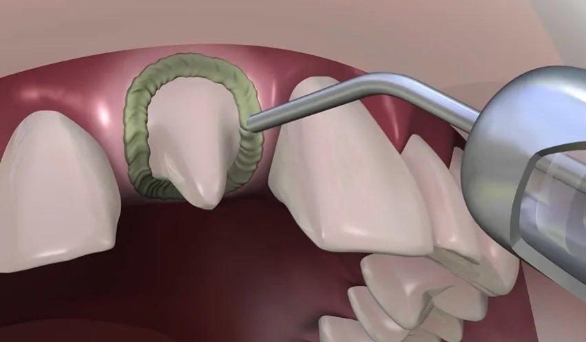 Prevest Hemostal Gel – Dental Hemostatic Gel for Gingival Retraction & Bleeding Control