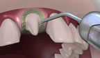 Prevest Hemostal Gel – Dental Hemostatic Gel for Gingival Retraction & Bleeding Control