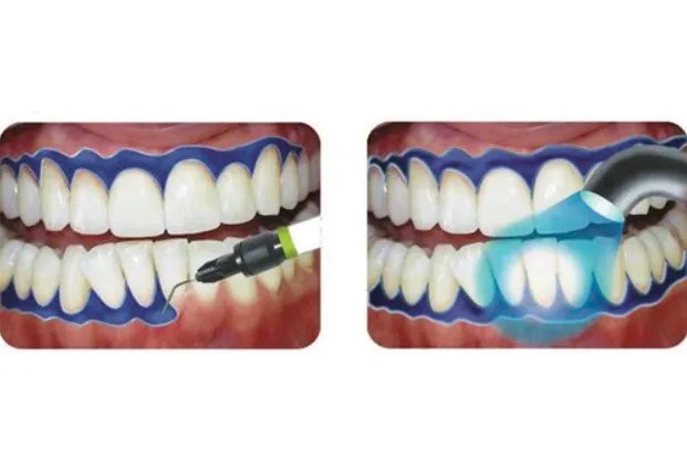 Prevest Gingiva Shield VLC – Light Cure Gingival Barrier Protection Gel