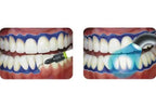 Prevest Gingiva Shield VLC – Light Cure Gingival Barrier Protection Gel