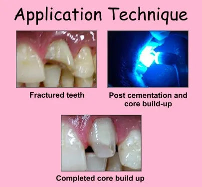 Prevest Fusion Core DC Flo Dual Cure Core Build Up Composite – 9gm