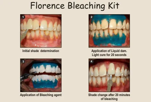 Prevest Florence Teeth Whitening Kit – Professional Carbamide Peroxide Whitening System