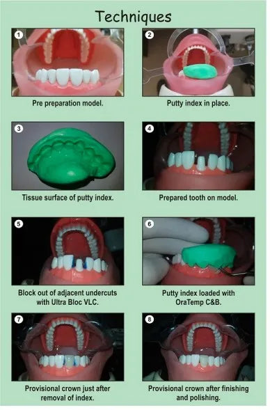 Prevest OraTemp C&B Temporary Crown & Bridge Cement – Strong, Easy-to-Use Dental Cement