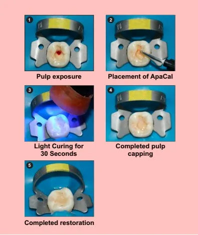 Prevest Apacal ART Light Cure Calcium Hydroxide Liner – Radiopaque Pulp Protection Material