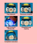 Prevest Apacal ART Light Cure Calcium Hydroxide Liner – Radiopaque Pulp Protection Material