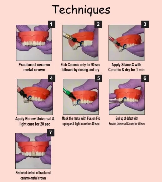 Prevest A.C.E Ceramic Repair Kit – Intraoral Porcelain Repair Kit with Silane for Strong Bonding