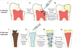 Prevest Dolo Endogel paste applied with applicator tip