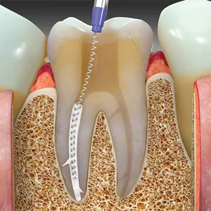 Prevest Zical Automix Dental Cement – Radiopaque Calcium Hydroxide Base with Automix System