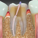 Prevest Zical Automix Dental Cement – Radiopaque Calcium Hydroxide Base with Automix System