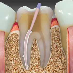 Prevest Zical Automix Dental Cement – Radiopaque Calcium Hydroxide Base with Automix System