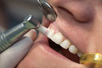 Prevest Platina Hi-Gloss Prophy Paste – Dental Polishing Paste for Stain & Plaque Removal