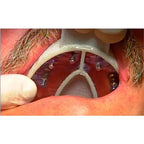 Cotisen Implant Impression Tray